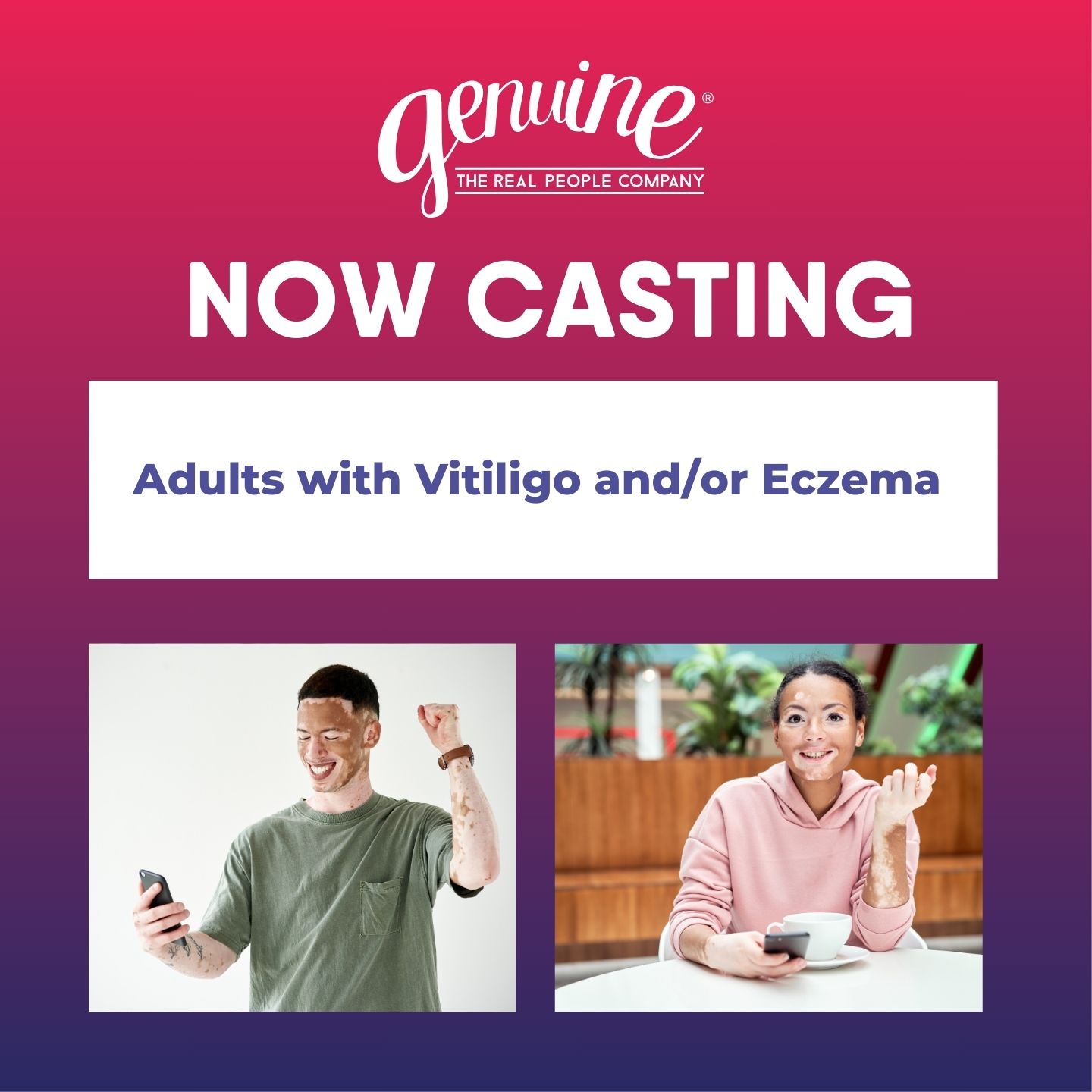 CASTING: ADULTS 18+ WITH VITILIGO AND/OR ECZEMA