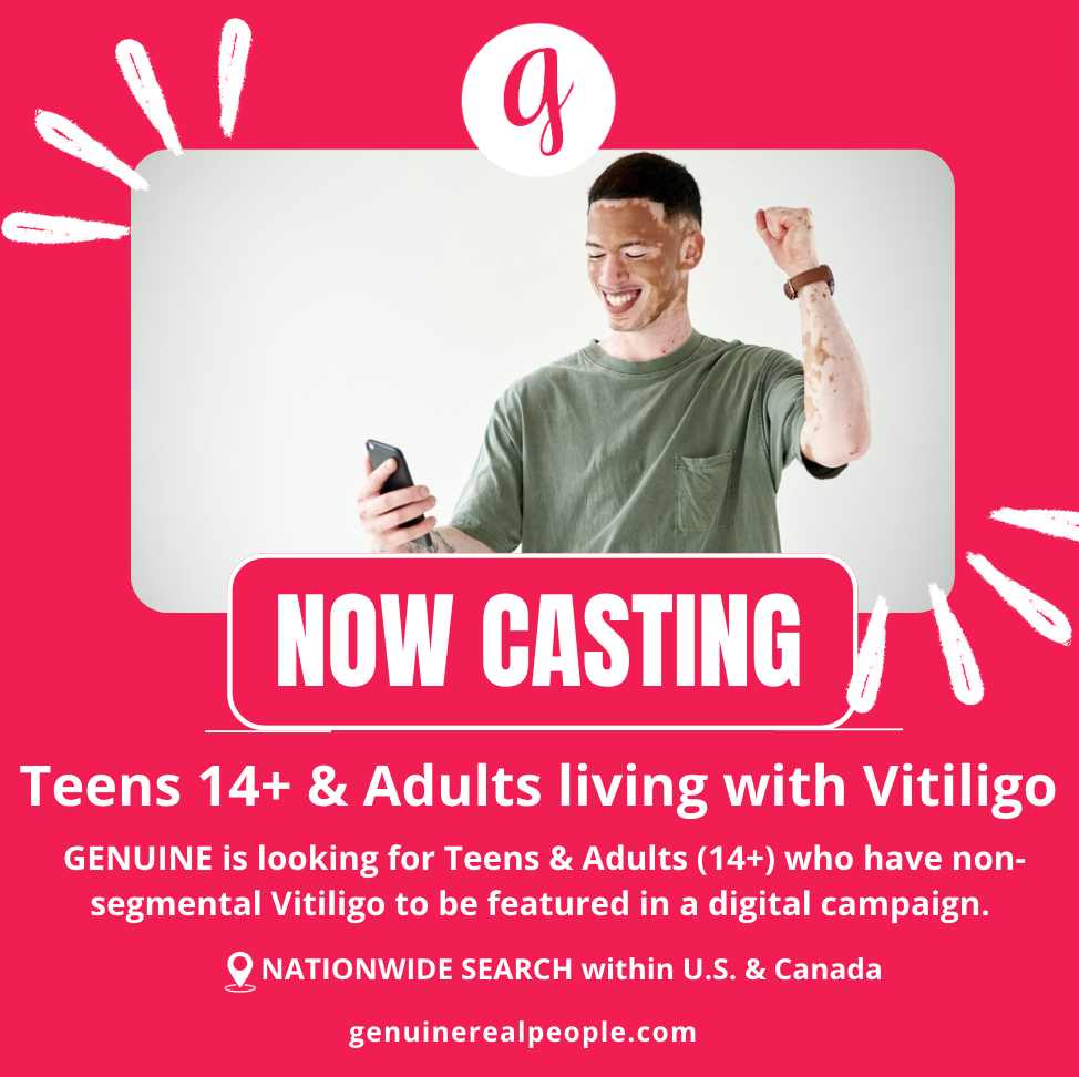 NOW CASTING: Teens 14+ & Adults with Non-Segmental Vitiligo